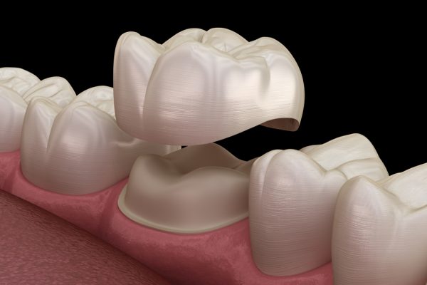 Dental Implant3